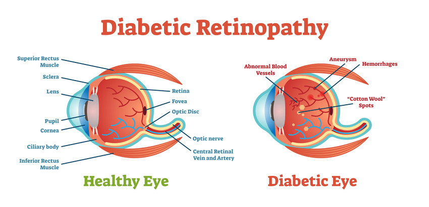 Diabetic Retinopathy  | Dittman Eyecare
