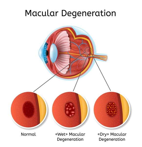 Macular Degeneration Vector Medical Scheme  | Dittman Eyecare