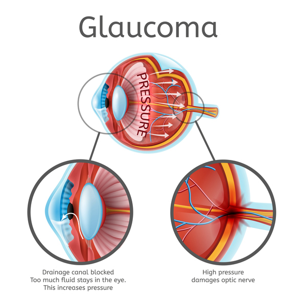 Glaucoma Vector Medical Scheme with Explanations  | Dittman Eyecare