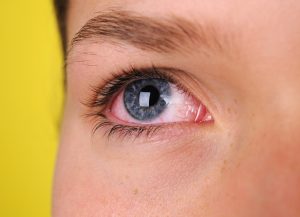 Dealing with a Scratched Eye  | Dittman Eyecare
