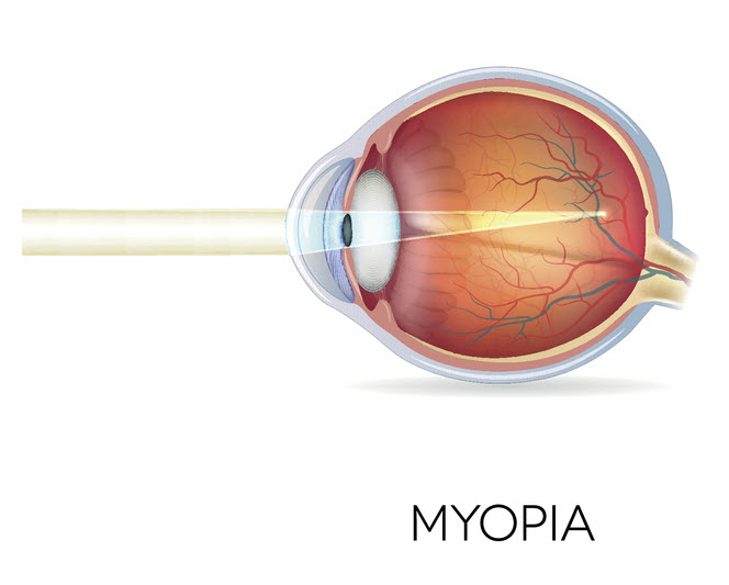 Myopia Diagram  | Dittman Eyecare