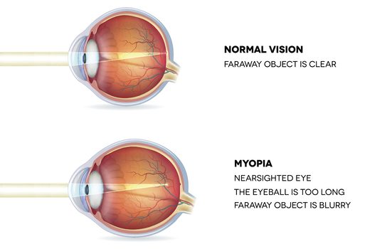 Myopia and normal vision Myopia is being shortsighted  | Dittman Eyecare