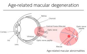 Age-Related Macular Degeneration: Signs, Risk Factors, and Treatment  | Dittman Eyecare