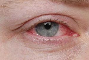 Conjunctivitis (Red Eye): Causes, Symptoms, and Remedies